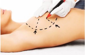 Capsular Contracture is a risk of breast augmentation