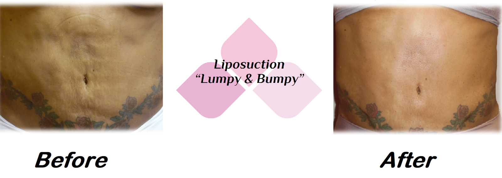 Lipo_BeforeandAfter.MarchPromo