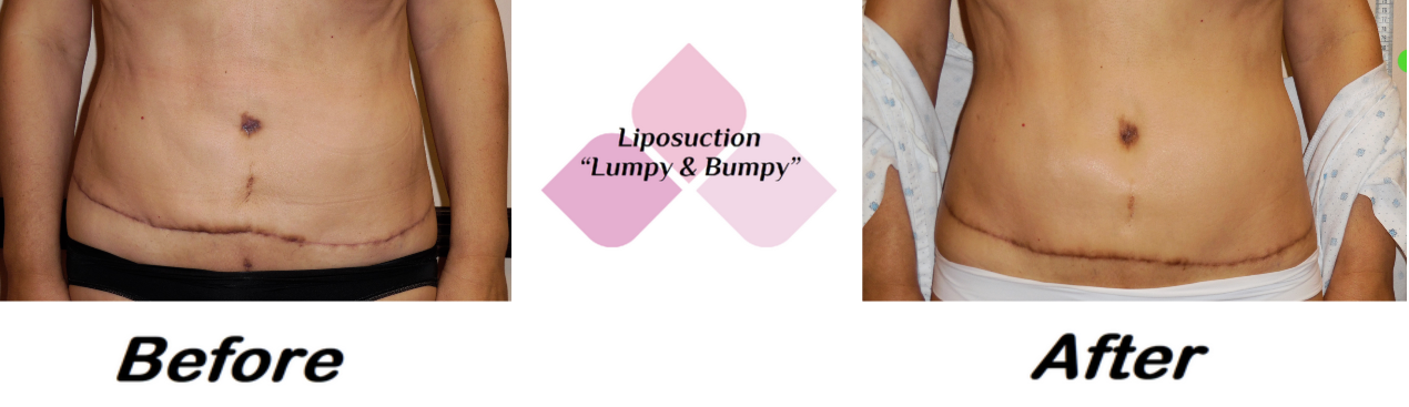 Liposuction lumpy and bumpy