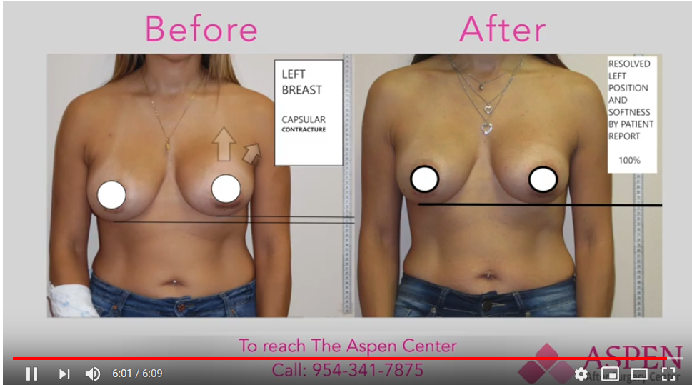 Breast Treatment