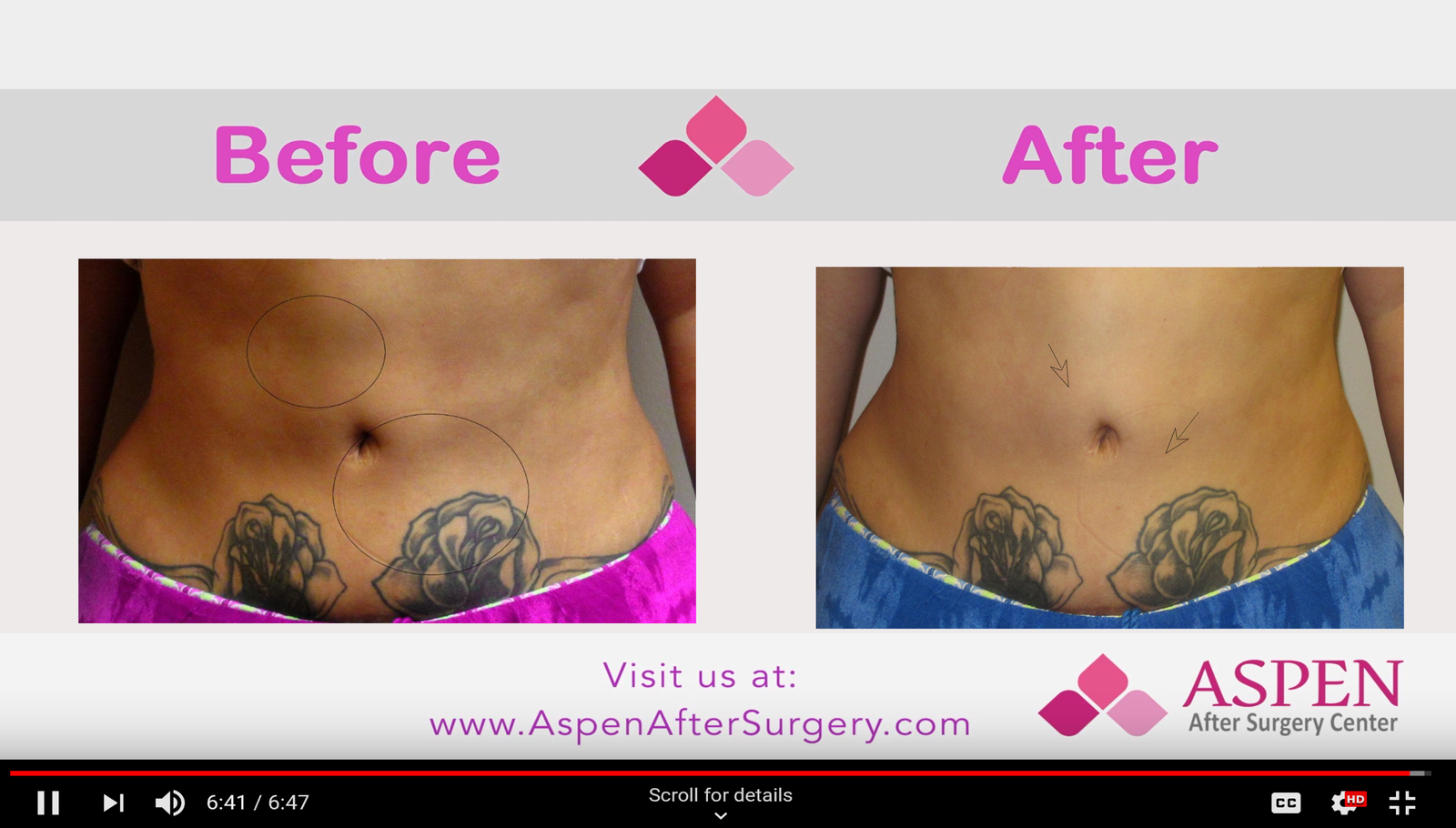 Breast Augmentation