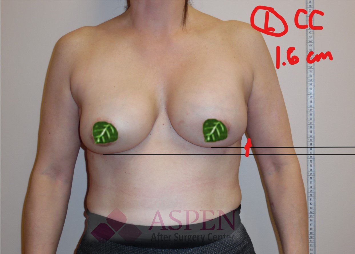 capsular contracture treatment