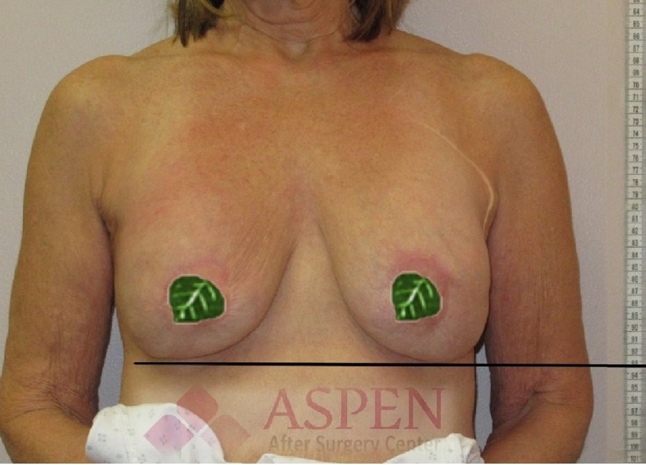 Capsular Contractual Treatment