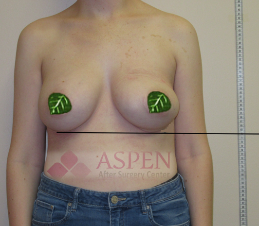 breast-implants-532x465