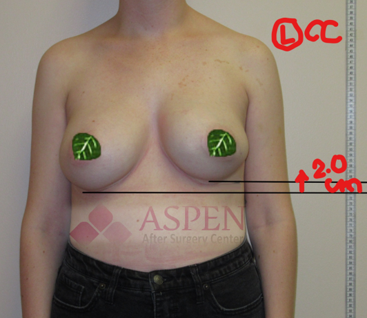 breast-surgery-532x461