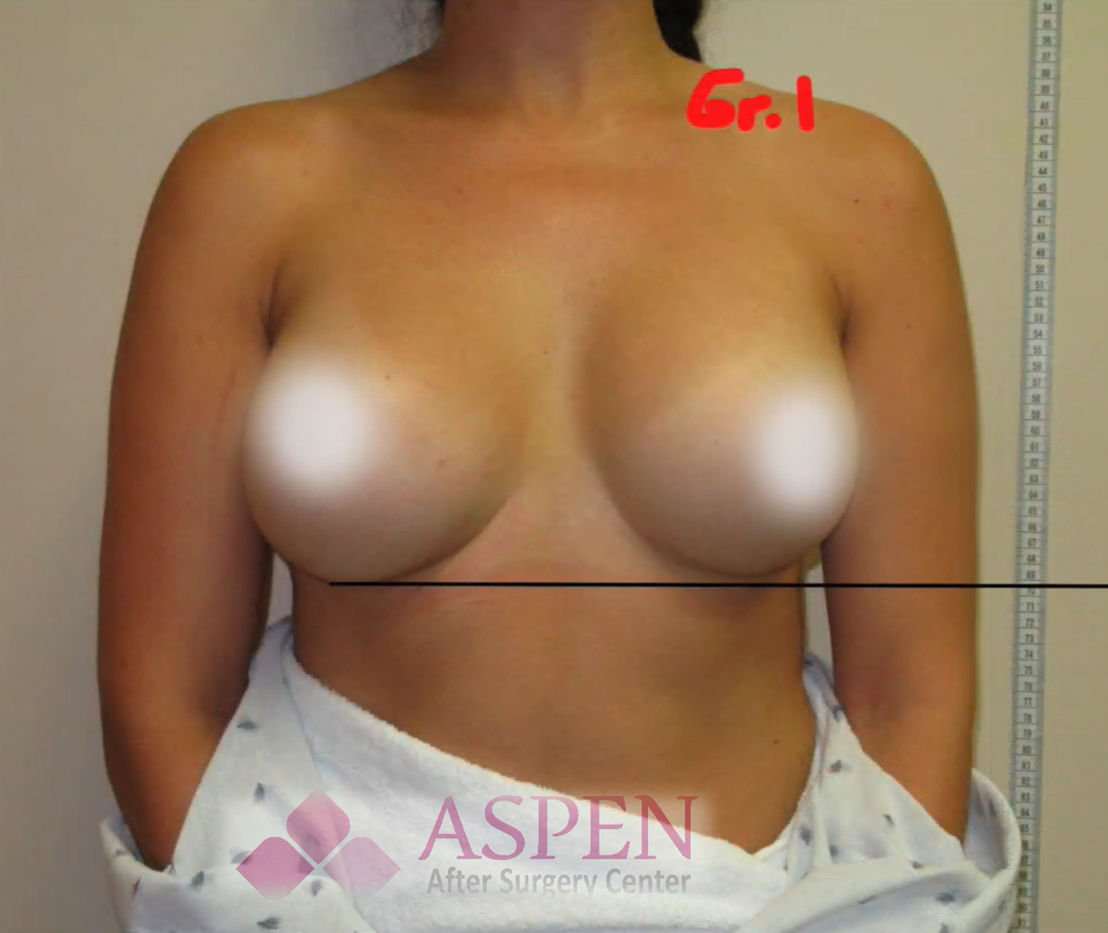 Breast reconstruction capsular contracture