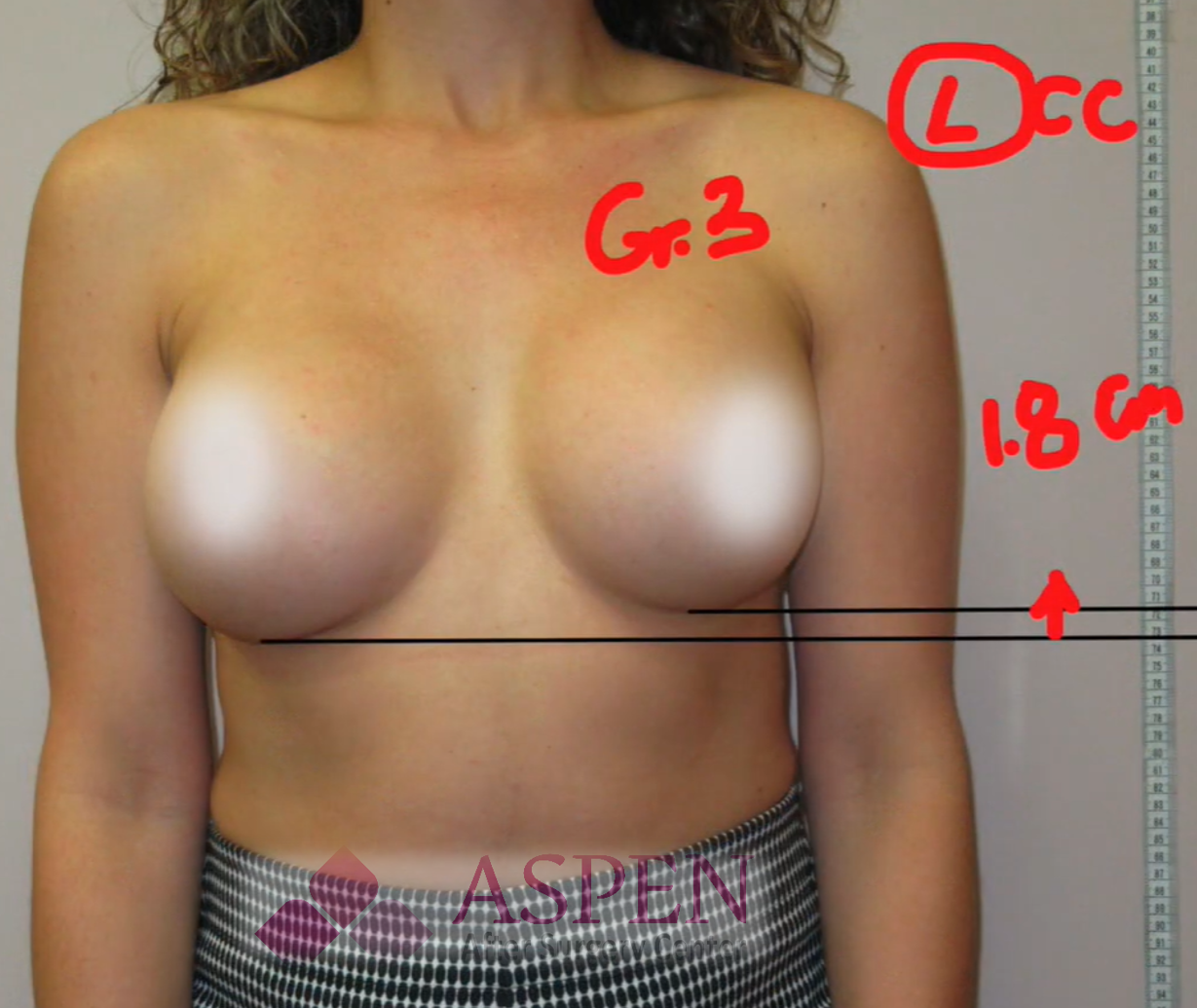 Breast reconstruction capsular contracture