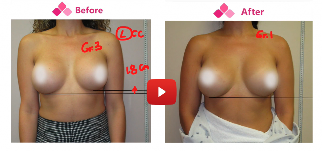 CAPSULAR CONTRACTURE OF THE BREAST