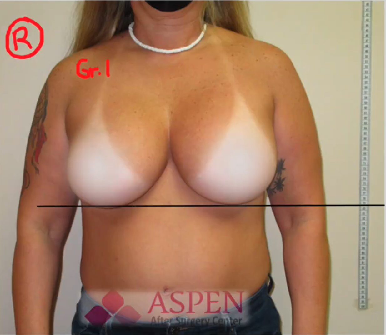 CAPSULAR CONTRACTURE OF THE BREAST