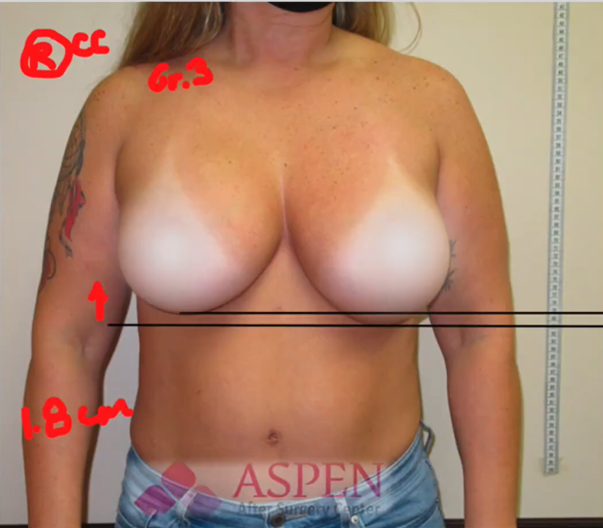 CAPSULAR CONTRACTURE OF THE BREAST