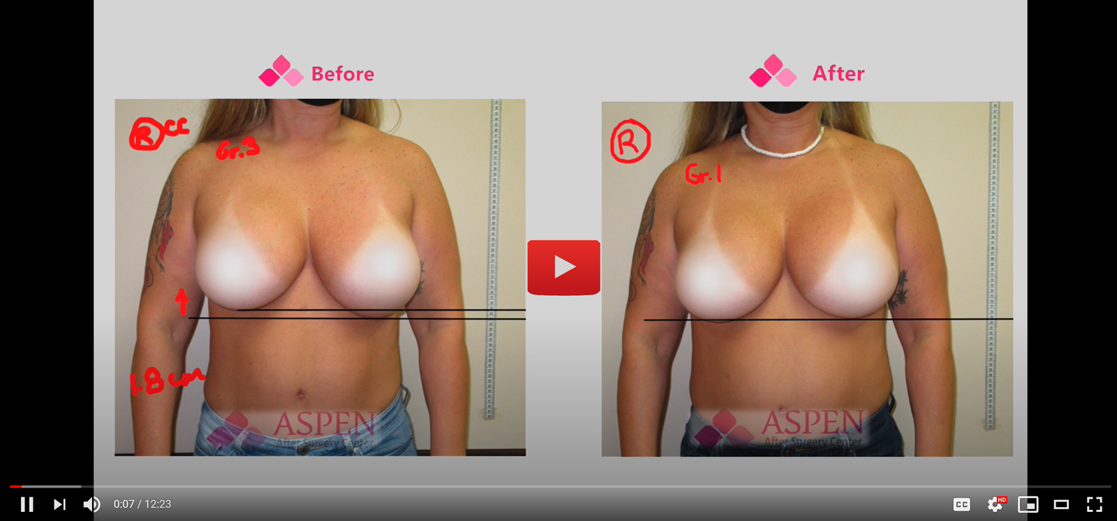 CAPSULAR CONTRACTURE OF THE BREAST