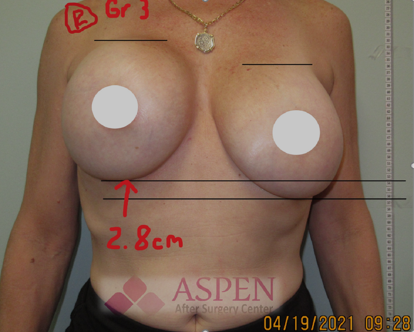 capsular contracture after breast reconstruction