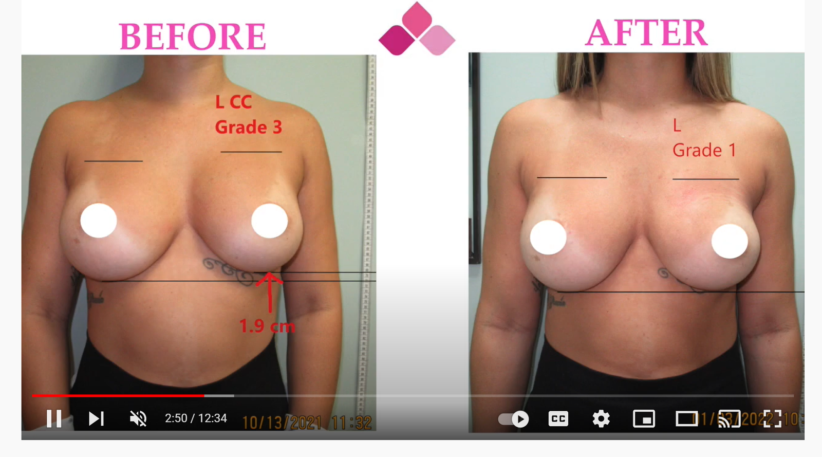 Breast reconstruction capsular contracture