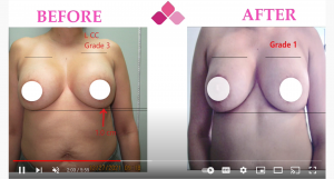 Breast reconstruction capsular contracture
