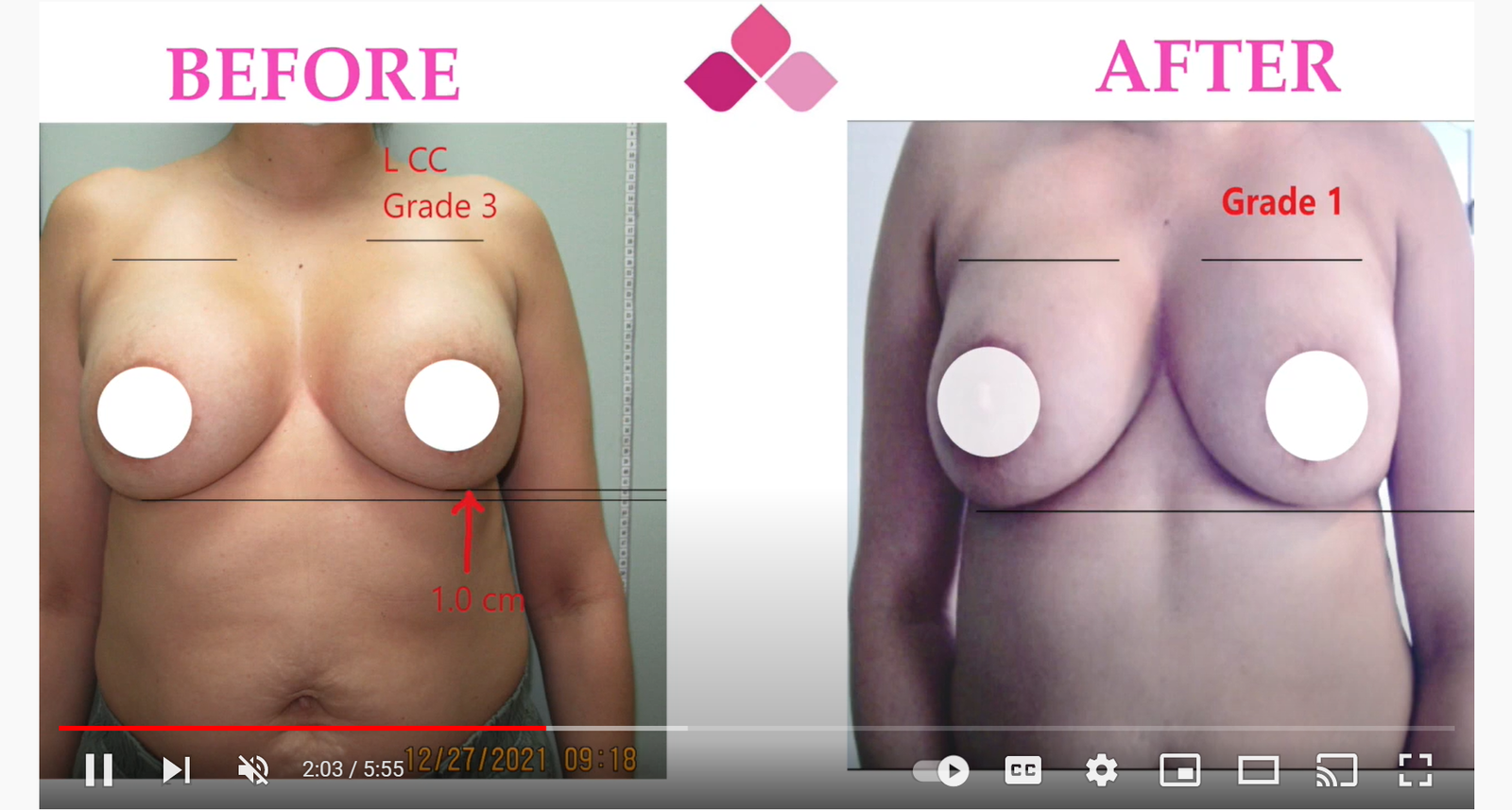 Breast reconstruction capsular contracture