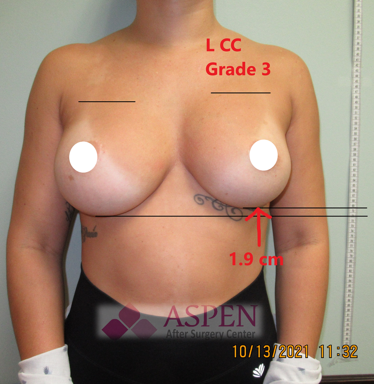 breast reconstruction