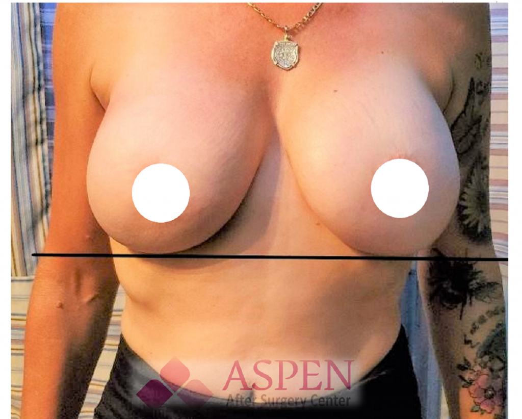 Breast reconstruction implant capsular contracture