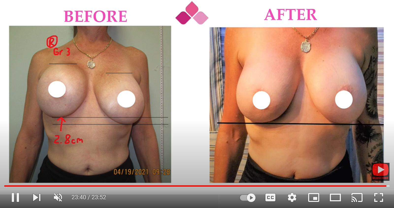 Breast reconstruction capsular contracture