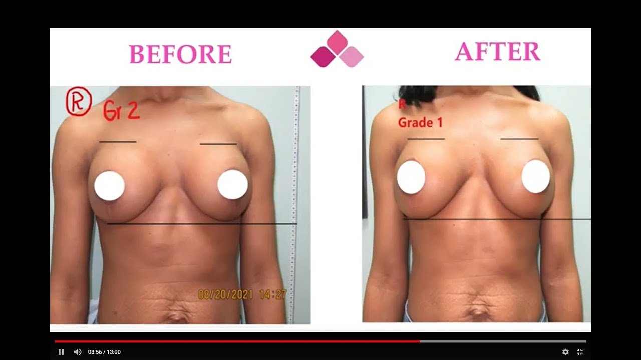 Capsular Contracture