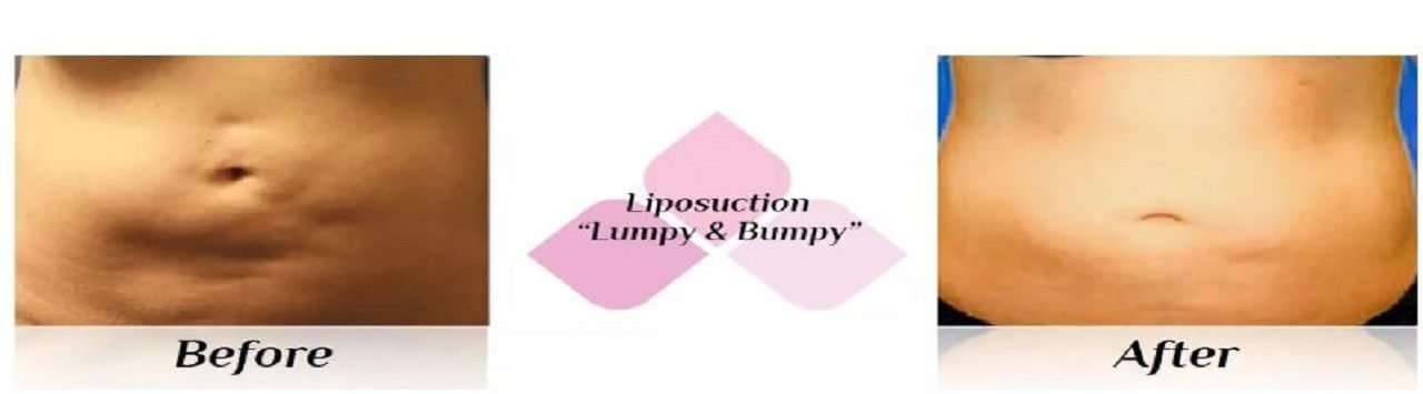 liposuction fibrosis