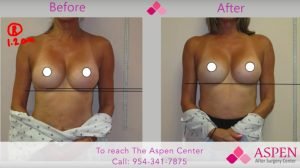 breast implant capsular contracture